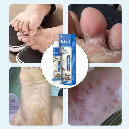 康凈衛生用品 專業止癢噴劑廠家在線咨詢，您的個人衛生守護者